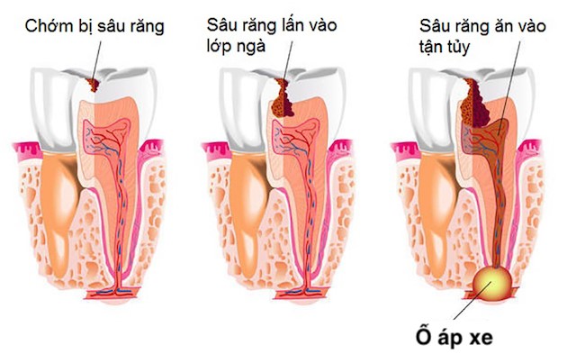 áp xe răng số 8