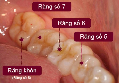 áp xe răng số 8