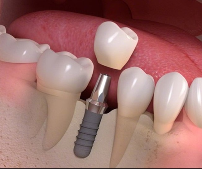 Biến chứng khi trồng răng implant