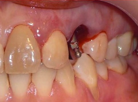 Biến chứng khi trồng răng implant