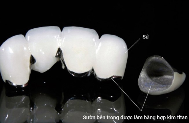 Bọc răng sứ giữ được bao lâu?