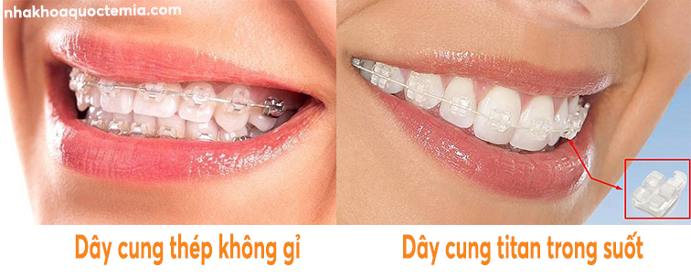 Các phương pháp niềng răng hiện nay