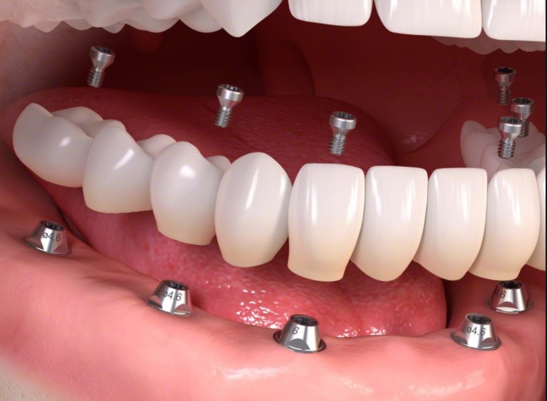 Cấy ghép implant có niềng răng được không?