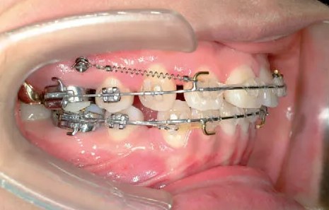 Cấy ghép implant có niềng răng được không?