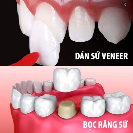 Dán răng sứ và bọc răng sứ cái nào tốt hơn?