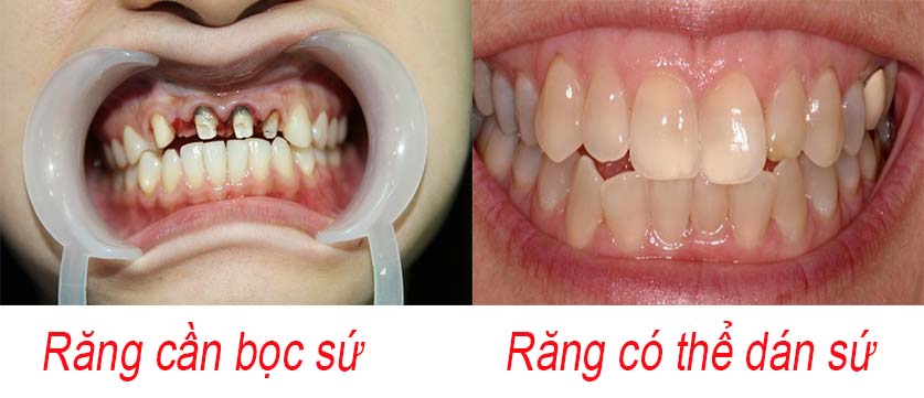 Dán răng sứ và bọc răng sứ cái nào tốt hơn?