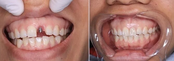 Nên ăn gì sau khi trồng răng implant?