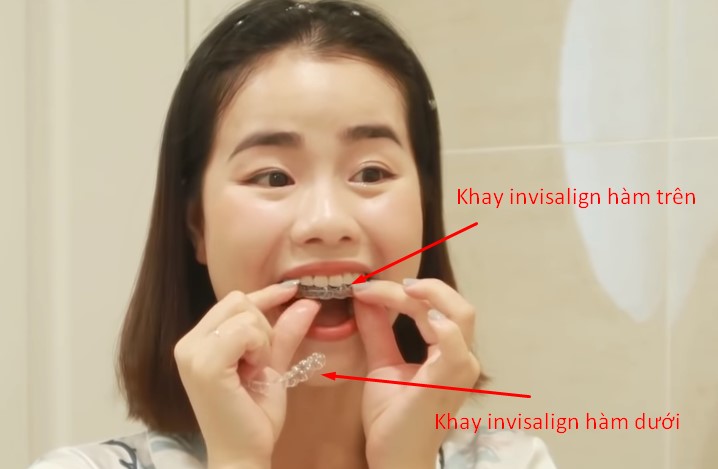 Niềng răng không mắc cài invisalign