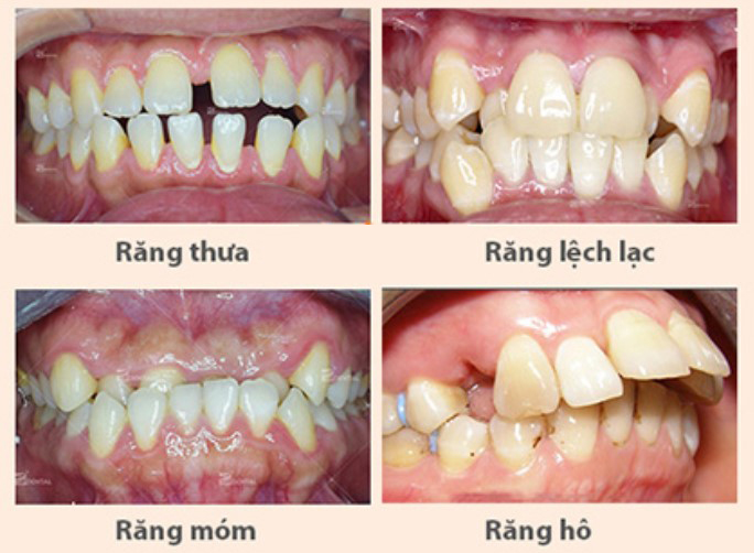 Niềng răng mắc cài sứ có hiệu quả không?