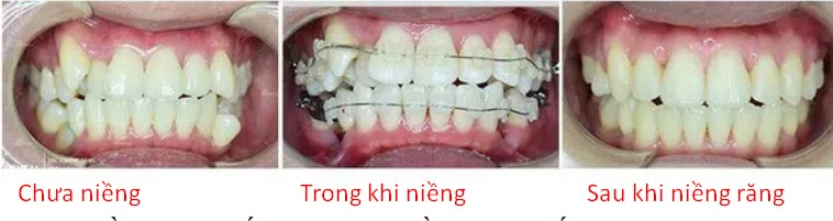 Niềng răng mắc cài sứ có hiệu quả không?