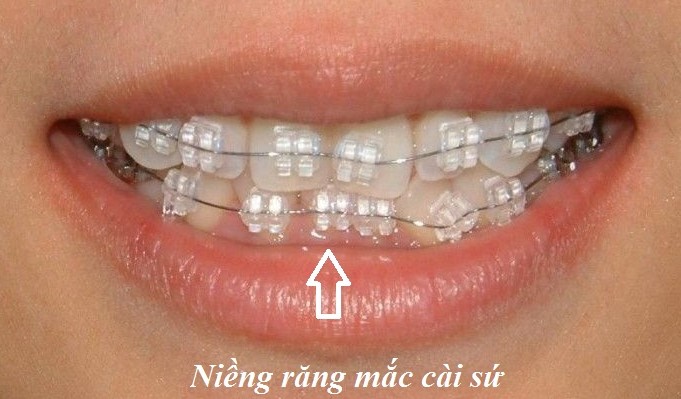 Niềng răng mắc cài sứ dây trong