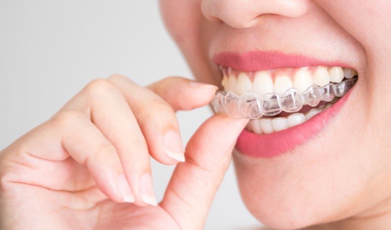 Tại sao niềng răng invisalign là xu hướng