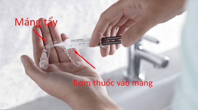 Tẩy trắng răng tại nhà giá bao nhiêu