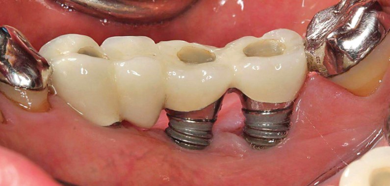 Trồng răng Implant có đau không?