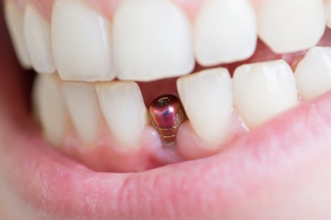 Trồng răng Implant có đau không?