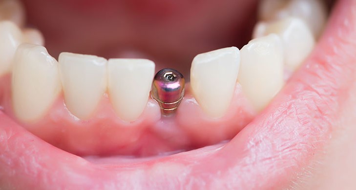 Trồng răng Implant có đau không?