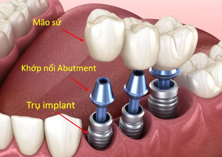 Trồng răng implant là gì