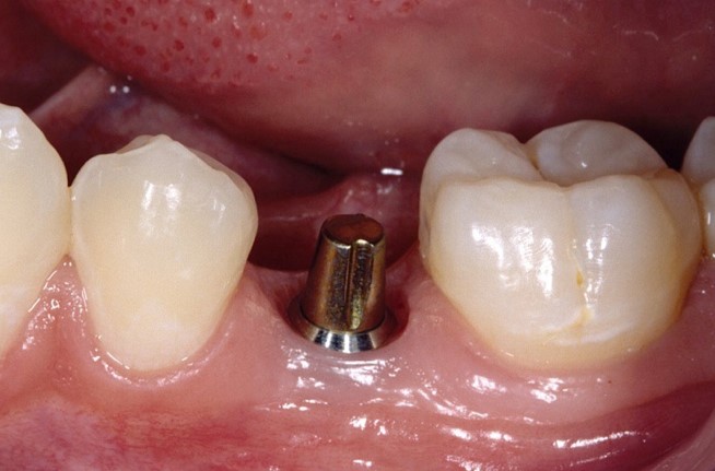 Trồng răng implant là gì