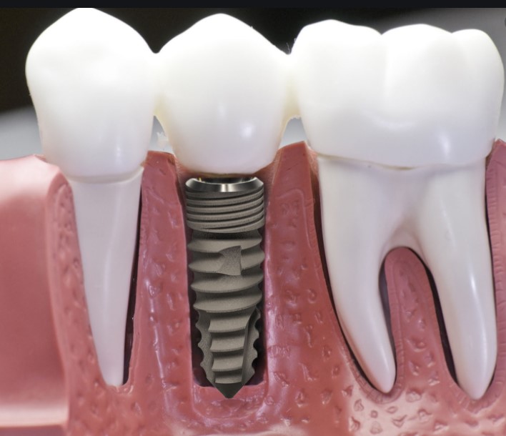 Trồng răng implant là gì