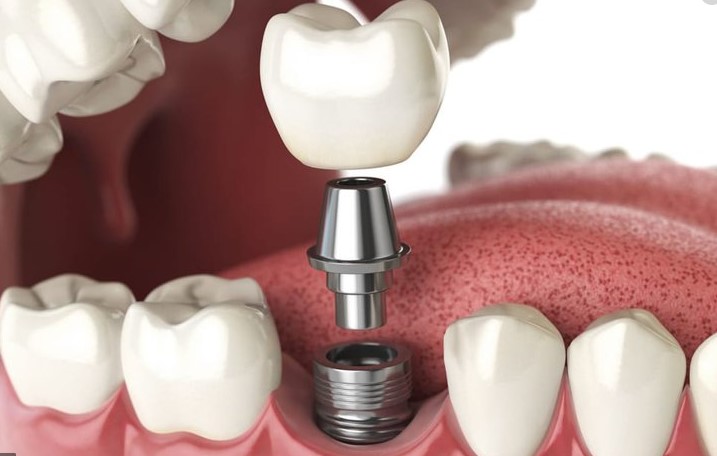 Trồng răng implant là gì