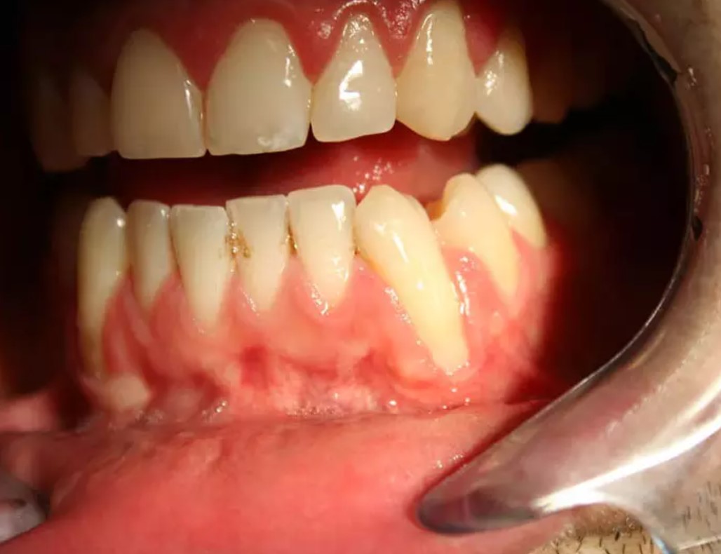 Tụt lợi có tự khỏi không