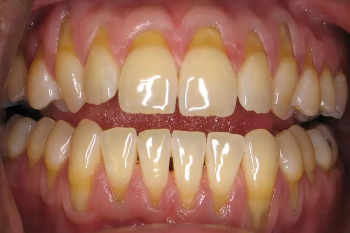 Tụt lợi có tự khỏi không