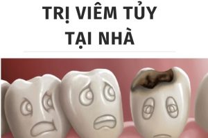 điều trị viêm tủy răng tại nhà