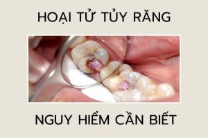 hoại tử tủy răng là gì