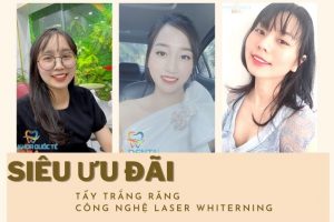 Khuyến mãi tẩy trắng răng công nghệ Laser Whiterning mới nhất hiện nay.