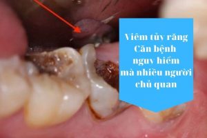 viêm tủy răng có nguy hiểm không